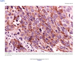 432 Patología especial
FIGURA 14-12. Metástasis de carcinoma prostático en ganglio linfático supraclavicular con estudio inmunohistoquímico (técnica de inmunoperoxidasa). Las células malignas son positivas
con el anticuerpo contra el antígeno prostático específico y confirma que el tumor primario está en la próstata. Esta técnica es muy específica y sensible y permite diagnosticar tumores
poco diferenciados.
© 2007 Editorial Médica Panamericana, S.A de C.V.
Cisfarm
 