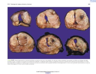 C14 Patología de vejiga, próstata y testículo 433
FIGURA 14-13. Macroscópicamente el carcinoma prostático se observa como uno o más nódulos, de color gris o blanco amarillento, que pueden ser difíciles de distinguir del tejido
prostático vecino. La mayoría se encuentra en la periferia de la glándula. La palpación puede facilitar su localización ya que por lo general existe induración por desmoplasia. En un alto
porcentaje (80%) la neoplasia es multifocal, pero muchas de las zonas con carcinoma sólo se podrán identificar microscópicamente. En este caso la próstata muestra además un área de
infarto hemorrágico en el tercer corte de arriba a la derecha.
© 2007 Editorial Médica Panamericana, S.A de C.V.
Cisfarm
 