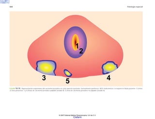 434 Patología especial
FIGURA 14-14. Representación esquemática del carcinoma prostático en corte axial de la próstata. Generalmente periféricos; 80% multicéntricos; la mayoría en lóbulo posterior. 1) Uretra.
2) Zona periuretral. 3 y 4) Áreas de carcinoma prostático palpable (estadio B). 5) Área de carcinoma prostático no palpable (estadio A).
© 2007 Editorial Médica Panamericana, S.A de C.V.
Cisfarm
 