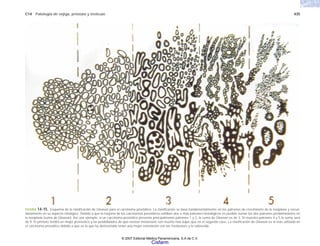 C14 Patología de vejiga, próstata y testículo 435
FIGURA 14-15. Esquema de la clasificación de Gleason para el carcinoma prostático. La clasificación se basa fundamentalmente en los patrones de crecimiento de la neoplasia y secun-
dariamente en su aspecto cítológico. Debido a que la mayoría de los carcinomas prostáticos exhiben dos o más patrones histológicos es posible sumar los dos patrones predominantes en
la neoplasia (suma de Gleason). Así, por ejemplo, si un carcinoma prostático presenta principalmente patrones 1 y 2, la suma de Gleason es de 3. Si muestra patrones 4 y 5 la suma será
de 9. El primero tendrá un mejor pronóstico y las posibilidades de que existan metástasis son mucho más bajas que en el segundo caso. La clasificación de Gleason es la más utilizada en
el carcinoma prostático debido a que es la que ha demostrado tener una mejor correlación con las metástasis y la sobrevida.
© 2007 Editorial Médica Panamericana, S.A de C.V.
Cisfarm
 