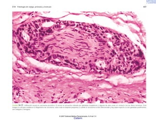 C14 Patología de vejiga, próstata y testículo 437
FIGURA 14-17. Infiltración neural en carcinoma prostático. El nervio se encuentra rodeado por glándulas neoplásicas y algunas de ellas están en contacto con las fibras nerviosas. Esta
imagen es útil para establecer el diagnóstico de carcinoma, sobre todo en biopsias pequeñas o cuando el carcinoma es bien diferenciado y hay duda respecto a si las glándulas proliferantes
son malignas o benignas.
© 2007 Editorial Médica Panamericana, S.A de C.V.
Cisfarm
 