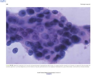 438 Patología especial
FIGURA 14-18. Biopsia por aspiración en un caso de carcinoma prostático moderadamente diferenciado. Las células muestran variación en su tamaño y en algunas de ellas hay atipia con
nucleolos aparentes. La certeza diagnóstica con este método es muy alta, particularmente en las neoplasias moderadamente y poco diferenciadas. (Cortesía del Dr. Armando Gamboa).
© 2007 Editorial Médica Panamericana, S.A de C.V.
Cisfarm
 