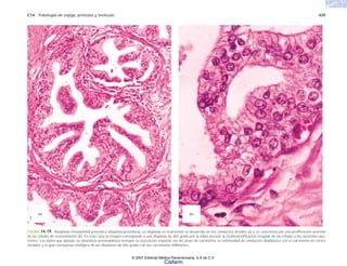 C14 Patología de vejiga, próstata y testículo 439
FIGURA 14-19. Neoplasia intraepitelial prostática (displasia prostática). La displasia en la próstata se desarrolla en los conductos distales (a) y se caracteriza por una proliferación anormal
de las células de revestimiento (b). En este caso la imagen corresponde a una displasia de alto grado por la atipia nuclear, la multiestratificación irregular de las células y los nucleolos apa-
rentes. Los datos que apoyan su naturaleza preneoplásica incluyen su asociación espacial con las áreas de carcinoma, la continuidad de conductos displásicos con el carcinoma en cortes
seriados y la gran semejanza citológica de las displasias de alto grado con los carcinomas infiltrantes.
(b)
(a)
© 2007 Editorial Médica Panamericana, S.A de C.V.
Cisfarm
 