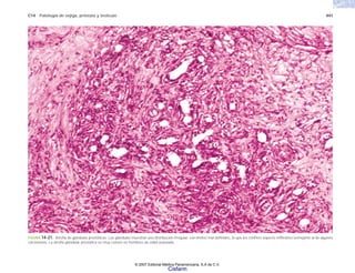 C14 Patología de vejiga, próstata y testículo 441
FIGURA 14-21. Atrofia de glándulas prostáticas. Las glándulas muestran una distribución irregular, con límites mal definidos, lo que les confiere aspecto infiltrativo semejante al de algunos
carcinomas. La atrofia glandular prostática es muy común en hombres de edad avanzada.
© 2007 Editorial Médica Panamericana, S.A de C.V.
Cisfarm
 