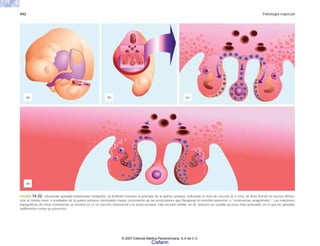 442 Patología especial
FIGURA 14-22. Desarrollo gonadal embrionario temprano. a) Embrión humano al principio de la quinta semana, indicando el nivel de sección (6.3 mm). b) Vista frontal en tercera dimen-
sión al mismo nivel, a mediados de la quinta semana, mostrando mayor crecimiento de las protrusiones que flanquean al intestino posterior, o “eminencias urogenitales”. Las relaciones
topográficas de estas eminencias se ilustran en c), en sección transversal a la sexta semana. Una sección similar, en d), muestra un estadio un poco más avanzado, en el que las gónadas
indiferentes están ya presentes.
(a) (b) (c)
(d)
© 2007 Editorial Médica Panamericana, S.A de C.V.
Cisfarm
 