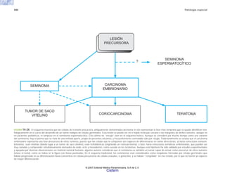444 Patología especial
FIGURA 14-24. El esquema muestra que las células de la lesión precursora, antiguamente denominada carcinoma in situ representan la fase más temprana que se puede identificar mor-
fológicamente en el curso del desarrollo de un tumor maligno de células germinales. Esta lesión se puede ver en el tejido testicular cercano a las márgenes de dichos tumores, aunque no
en pacientes pediátricos, ni tampoco en el seminoma espermatocítico. Este último no “encaja” bien en el esquema teórico. Aunque se consideró por mucho tiempo como una variante
del seminoma, hoy se piensa que se trata de una entidad aparte, propia de pacientes ancianos, y frecuentemente controlable sólo por cirugía. Tradicionalmente se acepta que el carcinoma
embrionario representa una fase precursora de otros tumores, puesto que las células que lo componen son capaces de diferenciarse en varias direcciones: a) hacia estructuras extraem-
brionarias, sean vitelinas (dando lugar a un tumor de saco vitelino), sean trofoblásticas (originando un coriocarcinoma), o bien, hacia estructuras somáticas embrionarias, que pueden ser
muy variadas y comprender simultáneamente derivados de endo, ecto y mesodermo, como sucede en los teratomas. Aunque esta hipótesis ha sido validada por estudios experimentales
y apoyada por diversas observaciones en material tumoral humano, algunos autores consideran que el seminoma es también un tumor capaz de actuar como precursor de otros tumores
(véase el texto), como se indica en la figura con líneas punteadas. En el esquema tradicional, los seminomas eran considerados como neoplasias formadas por células germinales que
habían progresado en su diferenciación hasta convertirse en células precursoras de células sexuales, o gonocitos, y se habían “congelado” en ese estado, por lo que no fueron ya capaces
de mayor diferenciación.
SEMINOMA
ESPERMATOCÍTICO
SEMINOMA
TUMOR DE SACO
VITELINO TERATOMA
LESIÓN
PRECURSORA
CARCINOMA
EMBRIONARIO
CORIOCARCINOMA
?
© 2007 Editorial Médica Panamericana, S.A de C.V.
Cisfarm
 