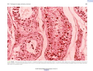 C14 Patología de vejiga, próstata y testículo 445
FIGURA 14-25. Lesión precursora del cáncer testicular, o neoplasia intratubular de células germinales (NICG). Se observan células atípicas que reemplazan la estructura normal de un
túbulo seminífero. La tinción inmunohistoquímica hace uso de un anticuerpo antifosfatasa alcalina placentaria, y revela la inmunorreactividad (cromógeno rojo) de las células anormales,
sobre todo en la membrana celular.
© 2007 Editorial Médica Panamericana, S.A de C.V.
Cisfarm
 