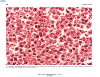 446 Patología especial
FIGURA 14-26. Histopatología del seminoma. Aspecto característico del seminoma testicular, compuesto por un tipo celular predominante, con citoplasma abundante, membranas celu-
lares bien definidas y núcleos grandes, con nucleolo prominente.
© 2007 Editorial Médica Panamericana, S.A de C.V.
Cisfarm
 