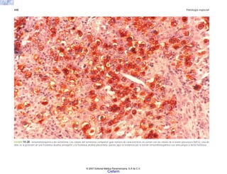 448 Patología especial
FIGURA 14-28. Inmunohistoquímica del seminoma. Las células del seminoma comparten gran número de características en común con las células de la lesión precursora (NICG). Una de
ellas es la posesión de una fosfatasa alcalina semejante a la fosfatasa alcalina placentaria, puesta aquí en evidencia por la tinción inmunohistoquímica con anticuerpos a dicha fosfatasa.
© 2007 Editorial Médica Panamericana, S.A de C.V.
Cisfarm
 