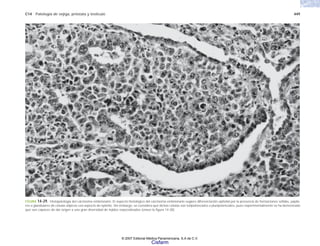 C14 Patología de vejiga, próstata y testículo 449
FIGURA 14-29. Histopatología del carcinoma embrionario. El aspecto histológico del carcinoma embrionario sugiere diferenciación epitelial por la presencia de formaciones sólidas, papila-
res o glandulares de células atípicas con aspecto de epitelio. Sin embargo, se considera que dichas células son totipotenciales o pluripotenciales, pues experimentalmente se ha demostrado
que son capaces de dar origen a una gran diversidad de tejidos especializados (véase la figura 14-38).
© 2007 Editorial Médica Panamericana, S.A de C.V.
Cisfarm
 