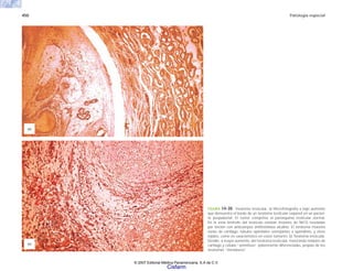 450 Patología especial
FIGURA 14-30. Teratoma testicular. a) Microfotografía a bajo aumento
que demuestra el borde de un teratoma testicular expansil en un pacien-
te pospubertal. El tumor comprime el parénquima testicular normal.
En la zona limítrofe del testículo existían lesiones de NICG reveladas
por tinción con anticuerpos antifosfatasa alcalina. El teratoma muestra
zonas de cartílago, túbulos epiteliales semejantes a epéndimo, y otros
tejidos, como es característico en estos tumores. b) Teratoma testicular.
Detalle, a mayor aumento, del teratoma testicular, mostrando nódulos de
cartílago y células “primitivas” pobremente diferenciadas, propias de los
teratomas “inmaduros”.
(b)
(a)
© 2007 Editorial Médica Panamericana, S.A de C.V.
Cisfarm
 