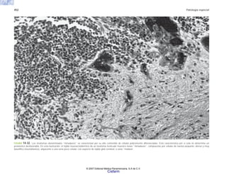 452 Patología especial
FIGURA 14-32. Los teratomas denominados “inmaduros” se caracterizan por su alto contenido de células pobremente diferenciadas. Esta característica por sí sola no determina un
pronóstico desfavorable. En esta ilustración, el tejido neuroectodérmico de un teratoma testicular muestra zonas “inmaduras”, compuestas por células de núcleo pequeño, denso y muy
basofílico (neuroblastos), adyacente a una zona poco celular, con aspecto de tejido glial cerebral, o zona “madura”.
© 2007 Editorial Médica Panamericana, S.A de C.V.
Cisfarm
 
