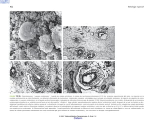 456 Patología especial
FIGURA 14-36. Poliembrioma y “cuerpos embrioides”. Cuando las células primitivas, o células de carcinoma embrionario (CCE) del teratoma experimental del ratón, se inyectan en la
cavidad peritoneal de un ratón recipiente, se obtiene la formación de numerosos corpúsculos celulares esferoidales que semejan un embrión temprano. a) Aspecto de algunos de estos
corpúsculos, o cuerpos embrioides, en el líquido ascítico hemorrágico, rodeados de eritrocitos (microscopio de barrida, X 700). Experimentalmente, en el ratón, el desarrollo de un teratoma
empieza pareciéndose a un embrión normal hasta la fase de aspecto “cilíndrico” (egg cylinder: aproximadamente séptimo día del embrión del ratón), después de la cual los tejidos se des-
organizan y proliferan en la forma caótica, propia de los teratomas, en lugar de crecer ordenadamente, como se espera en el embrión normal. También en los tumores de células germinales
del humano, sobre todo los teratomas malignos, se pueden observar ocasionalmente en algunos cuerpos embrioides, como los que se ilustran en b) y c). La diferenciación tisular puede
ser notable en los embrioides. d) Diferenciación hacia alantoides. La parte periférica del embrioide se diferencia hacia trofoblasto, en forma de célula gigante o sincicial multinucleada. Un
tumor de células germinales sumamente raro está constituido por gran número de cuerpos embrioides y por esta razón se designa como poliembrioma.
(a)
(b)
(c)
(d)
© 2007 Editorial Médica Panamericana, S.A de C.V.
Cisfarm
 