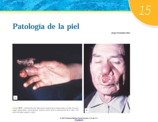 15
Patología de la piel
Jorge Fernández-Díez
Patología de la piel
FIGURA 15-1. a) Primoinfección tuberculosa cutánea de los dedos índice y medio. b) Lupus
vulgar (tuberculosis mucocutánea), eritema centro facial y deformación de la nariz, con
úlcera del labio superior y nariz.
(a)
(b)
© 2007 Editorial Médica Panamericana, S.A de C.V.
Cisfarm
 