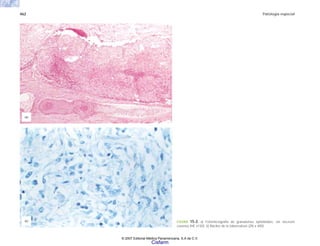 462 Patología especial
FIGURA 15-2. a) Fotomicrografía de granulomas epitelioides, sin necrosis
caseosa (HE x150). b) Bacilos de la tuberculosis (ZN x 400).
(a)
(b)
© 2007 Editorial Médica Panamericana, S.A de C.V.
Cisfarm
 
