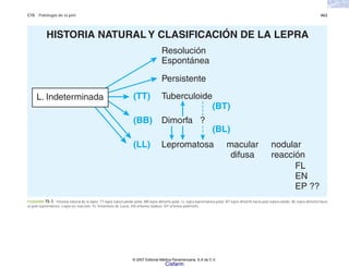 C15 Patología de la piel 463
ESQUEMA 15-1. Historia natural de la lepra. TT lepra tuberculoide polar, BB lepra dimorfa polar, LL lepra lepromatosa polar, BT lepra dimorfa hacia polo tuberculoide, BL lepra dimorfa hacia
el polo lepromatoso. Lepra en reacción, FL fenómeno de Lucio, EN eritema nodoso, EP eritema polimorfo.
HISTORIA NATURAL Y CLASIFICACIÓN DE LA LEPRA
Resolución
Espontánea
Persistente
Tuberculoide
(TT)
(BT)
(BL)
Dimorfa ?
(BB)
Lepromatosa macular
difusa
nodular
reacción
FL
EN
EP ??
(LL)
L. Indeterminada
© 2007 Editorial Médica Panamericana, S.A de C.V.
Cisfarm
 