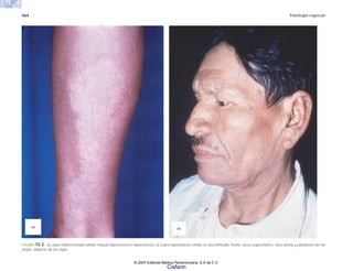 464 Patología especial
FIGURA 15-3. a) Lepra indeterminada exhibe mácula hipocrómica e hipoestésica. b) Lepra lepromatosa exhibe la cara infiltrada, frente, arcos superciliares, nariz ancha y pabellones de las
orejas, alopecia de las cejas.
(a) (b)
© 2007 Editorial Médica Panamericana, S.A de C.V.
Cisfarm
 