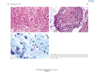 C15 Patología de la piel 465
FIGURA 15-4. Lepra lepromatosa, histiocitos vacuolados o células de Virchow (HE
x360). b) Lepra lepromatosa, tronco nervioso infiltrado por linfocitos e histiocitos vacuo-
lados (HE x150). c) Lepra lepromatosa, bacilos de la lepra en el citoplasma de histiocitos
(fite faraco x400).
(c)
(b)
(a)
© 2007 Editorial Médica Panamericana, S.A de C.V.
Cisfarm
 