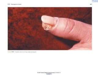 C15 Patología de la piel 467
FIGURA 15-5. Fotografía clínica de verruga vulgar paraungueal.
© 2007 Editorial Médica Panamericana, S.A de C.V.
Cisfarm
 