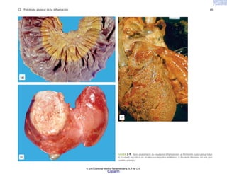 C3 Patología general de la inflamación 45
FIGURA 3-9. Tipos anatómicos de exudados inflamatorios. a) Peritonitis tuberculosa miliar.
b) Exudado necrótico en un absceso hepático amibiano. c) Exudado fibrinoso en una peri-
carditis urémica.
(a)
(b)
(c)
© 2007 Editorial Médica Panamericana, S.A de C.V.
Cisfarm
 
