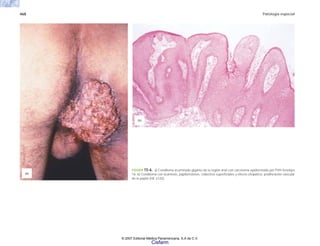 468 Patología especial
FIGURA 15-6. a) Condiloma acuminado gigante de la región anal con carcinoma epidermoide por PVH fenotipo
16. b) Condiloma con acantosis, papilomatosis, coilocitos superficiales y efecto citopático, proliferación vascular
de la papila (HE x125).
(b)
(a)
© 2007 Editorial Médica Panamericana, S.A de C.V.
Cisfarm
 