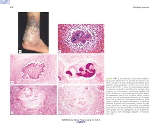 470 Patología especial
FIGURA 15-8. a) Micetoma por Actinomadura madurae,
pie y pierna deformados con aumento de volumen y tra-
yectos fistulosos. b) Grano de Nocardia brasiliensis, grano
pequeño, clavas pequeñas y anchas, en el seno de un
absceso (HE x150). c) Grano de Actinomadura madurae,
de aspecto cartográfico; sus filamentos se tiñen inten-
samente con hematoxilina, seudoclavas basófilos (HE
x180). d) Grano de Actinomadura pelletieri, grano peque-
ño, homogéneo, que se tiñe de violeta intenso, aspecto
de plato roto; no se distinguen filamentos en su interior
(HE x150). e) Grano de Streptomyces somaliensis, grano
grande, redondo, de aspecto homogéneo, en forma de
rebanada de patata con hematoxilina y eosina; de color
rosado pálido en el centro y más intenso en la periferia
(HE x150). f) Grano de Actinomyces israelii (micobacteria),
grano grande, filiforme, grampositivo, ácido alcohol resis-
tente negativo, filamentos largos, delgados y entrelazados
(HE x150).
(e)
(c)
(a)
(f)
(d)
(b)
© 2007 Editorial Médica Panamericana, S.A de C.V.
Cisfarm
 