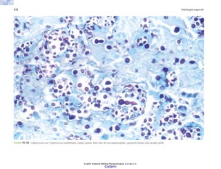 472 Patología especial
FIGURA 15-10. Criptococosis por Cryptococcus neoformans, espora grande, halo claro de mucopolisácaridos, gemación binaria (azul alciado x400).
© 2007 Editorial Médica Panamericana, S.A de C.V.
Cisfarm
 