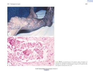 C15 Patología de la piel 473
FIGURA 15-11. a) Cromomicosis en las piernas, placas verrugosas. b)
Cromomicosis Phyalophora pedrosoi o esclerotes de Medler, esporas pig-
mentadas de café-negro con hematoxilina y eosina, en el interior de una
célula gigante multinucleada (HE x210).
(b)
(a)
© 2007 Editorial Médica Panamericana, S.A de C.V.
Cisfarm
 