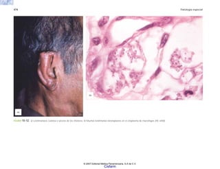 474 Patología especial
FIGURA 15-12. a) Leishmaniasis cutánea o úlceras de los chicleros. b) Muchas leishmanias kinetoplastos en el citoplasma de macrófagos (HE x400).
(b)
(a)
© 2007 Editorial Médica Panamericana, S.A de C.V.
Cisfarm
 