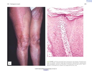 C15 Patología de la piel 475
FIGURA 15-13. a) Psoriasis de grandes placas eritematosas, bien limitadas. b) Detalle micros-
cópico de psoriasis, acantosis regular tipo psoriasiforme, hiperqueratosis, paraqueratosis,
atrofia suprapapilar, exocitosis de neutrófilos y microabscesos en la capa córnea “Munro”,
dilatación y tortuosidad de los capilares de la papila dérmica (HE x150).
(a)
(b)
© 2007 Editorial Médica Panamericana, S.A de C.V.
Cisfarm
 