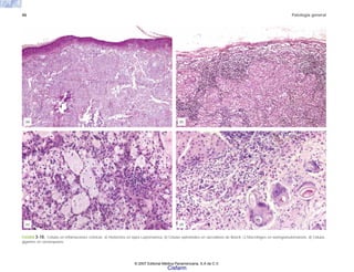 46 Patología general
FIGURA 3-10. Células en inflamaciones crónicas. a) Histiocitos en lepra Lepromatosa. b) Células epitelioides en sarcoidosis de Boeck. c) Macrófagos en xantogranulomatosis. d) Células
gigantes en clonorquiasis.
(a) (b)
(c) (d)
© 2007 Editorial Médica Panamericana, S.A de C.V.
Cisfarm
 