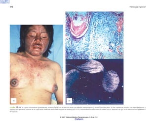 478 Patología especial
(b)
(a)
FIGURA 15-16. a) Lupus eritematoso generalizado, eritema facial con úlceras en tórax con pápulas hemorrágicas y úlceras por vasculitis. b) Piel, epidermis atrófica con hiperqueratosis y
tapones de queratina, edema de la capa basal, infiltrado linfocitario superficial (arriba) (HE x175). Inmunofluorescencia directa banda lúpica, depósito de IgG en la unión dermo-epidérmica
(IFD x175).
© 2007 Editorial Médica Panamericana, S.A de C.V.
Cisfarm
 