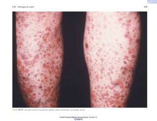 C15 Patología de la piel 479
FIGURA 15-17. Vasculitis cutánea en las piernas, pápulas, placas eritematosas, hemorragia, úlceras.
© 2007 Editorial Médica Panamericana, S.A de C.V.
Cisfarm
 