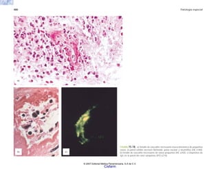 480 Patología especial
FIGURA 15-18. a) Detalle de vasculitis necrosante leucocitoclástica de pequeños
vasos; la pared exhibe necrosis fibrinoide, polvo nuclear y neutrófilos (HE x180).
b) Detalle de vasculitis necrosante de vasos pequeños (HE x350). c) Depósitos de
IgG en la pared del vaso sanguíneo (IFD x210).
(c)
(b)
(a)
© 2007 Editorial Médica Panamericana, S.A de C.V.
Cisfarm
 