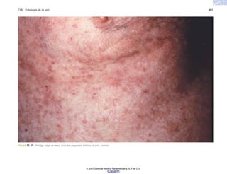 C15 Patología de la piel 481
FIGURA 15-19. Pénfigo vulgar en tórax, vesículas pequeñas, eritema, úlceras, costras.
© 2007 Editorial Médica Panamericana, S.A de C.V.
Cisfarm
 