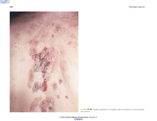 482 Patología especial
FIGURA 15-20. Pénfigo vegetante en la espalda, placas verrugosas y vesículas peque-
ñas, úlceras.
© 2007 Editorial Médica Panamericana, S.A de C.V.
Cisfarm
 