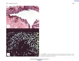 C15 Patología de la piel 483
FIGURA 15-21. a) Detalle de pénfigo vulgar, vesícula intraepitelial acantolítica (HE x210). b)
Inmunofluorescencia indirecta, depósitos de IgG no fija complemento, con patrón en malla,
alrededor de los queratinocitos (IFI x210).
(a)
(b)
© 2007 Editorial Médica Panamericana, S.A de C.V.
Cisfarm
 