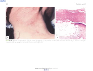 484 Patología especial
FIGURA 15-22. a) Eczema de contacto alérgico en el cuello, eritema, liqueinificación de la piel, huellas de rascado. b) Detalle microscópico de eczema alérgico, microvesícula intraepidér-
mica subcorneal del tipo espongiótica, exocitosis de linfocitos y eosinófilos (HE x150).
(a) (b)
© 2007 Editorial Médica Panamericana, S.A de C.V.
Cisfarm
 