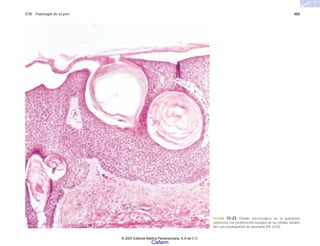 C15 Patología de la piel 485
FIGURA 15-23. Detalle microscópico de la queratosis
seborreica con proliferación benigna de las células basaloi-
des con seudoquistes de queratina (HE x125).
© 2007 Editorial Médica Panamericana, S.A de C.V.
Cisfarm
 