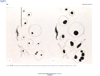 486 Patología especial
(a) (b)
FIGURA 15-24. Esquema de los tipos morfológicos de las células névicas y melanocitos tanto a) benignas como b) malignas. (Ackerman y cols., 1994.)
© 2007 Editorial Médica Panamericana, S.A de C.V.
Cisfarm
 