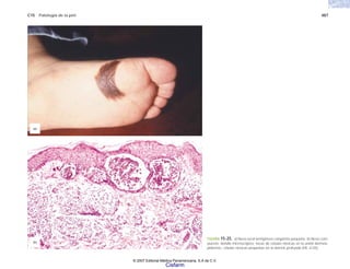 C15 Patología de la piel 487
FIGURA 15-25. a) Nevo acral lentiginoso congénito pequeño. b) Nevo com-
puesto; detalle microscópico; tecas de células névicas en la unión dermoe-
pidermis, células névicas pequeñas en la dermis profunda (HE x125).
(b)
(a)
© 2007 Editorial Médica Panamericana, S.A de C.V.
Cisfarm
 