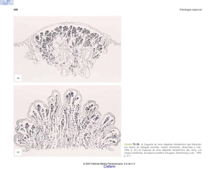 488 Patología especial
FIGURA 15-26. a) Esquema de nevo adquirido intradérmico tipo Miescher,
con silueta de triángulo invertido, células monótonas. (Ackerman y cols.,
1994, p. 50.) b) Esquema de nevo adquirido intradérmico tipo Unna, con
células monótonas, de aspecto exofítico verrugoso. (Ackermany y cols., 1994,
p. 47.)
(b)
(a)
© 2007 Editorial Médica Panamericana, S.A de C.V.
Cisfarm
 