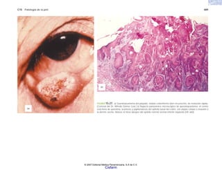 C15 Patología de la piel 489
FIGURA 15-27. a) Queratoacantoma del párpado, nódulo crateriforme bien circunscrito, de evolución rápida.
(Cortesía del Dr. Alfredo Gómez Leal.) b) Aspecto panorámico microscópico de queratoacantoma; el centro
está lleno de queratina, acantosis y papilomatosis del epitelio basal del cráter, con atipias células e invasión a
la dermis vecina. Nótese el inicio abrupto del epitelio normal vecinal inferior izquierdo (HE x60).
(a)
(b)
© 2007 Editorial Médica Panamericana, S.A de C.V.
Cisfarm
 