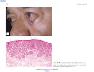 490 Patología especial
FIGURA 15-28. a) Carcinoma basocelular del tipo nodular ulcerado en el
párpado inferior, pigmentado, de bordes perlados. b) Carcinoma basocelular
nodular: los nidos neoplásicos de células basales están en la dermis superfi-
cial, y exhiben empalizada en la periferia (HE x75).
(b)
(a)
© 2007 Editorial Médica Panamericana, S.A de C.V.
Cisfarm
 