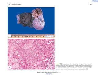 C15 Patología de la piel 491
FIGURA 15-29. a) Carcinoma epidermoide del tipo verrugoso del pene; se obser-
va la deformación del glande, la neoplasia blanquecina verrugosa bien limitada. b)
Carcinoma epidermoide bien diferenciado; forma mosaicos de células epiteliales,
hay disqueratosis, citoplasma claro, citoplasma eosinófilo, mitosis atípicas, for-
mación de perlas córneas, desproporción núcleo citoplasma (HE x125).
(a)
(b)
© 2007 Editorial Médica Panamericana, S.A de C.V.
Cisfarm
 