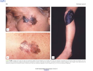 492 Patología especial
FIGURA 15-30. a) Mujer de 75 años de edad con melanoma maligno de tipo lentiginoso en la mejilla con 20 años de evolución; zona plana con crecimiento radial y los nódulos con creci-
miento vertical. b) Melanoma maligno de diseminación superficial en la pierna; siete años de evolución; crecimiento asimétrico, bordes irregulares, color irregular, áreas hipocrómicas de
regresión y nódulos de crecimiento vertical. c) Pierna de un niño con melanoma originado en nevo congénito de 14 x 10 cm con metástasis inguinales.
(a)
(b) (c)
© 2007 Editorial Médica Panamericana, S.A de C.V.
Cisfarm
 