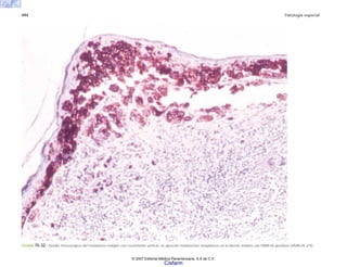 494 Patología especial
FIGURA 15-32. Detalle microscópico del melanoma maligno con crecimiento vertical; se aprecian melanocitos neoplásicos en la dermis teñidos con HMB-45 positivos (HMB-45 x75)
© 2007 Editorial Médica Panamericana, S.A de C.V.
Cisfarm
 