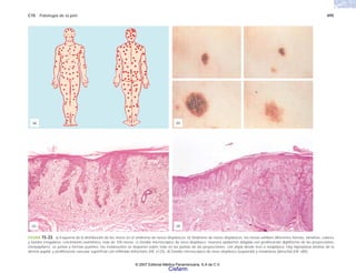 C15 Patología de la piel 495
FIGURA 15-33. a) Esquema de la distribución de los nevos en el síndrome de nevos displásicos. b) Síndrome de nevos displásicos; los nevos exhiben diferentes formas, tamaños, colores
y bordes irregulares, crecimiento asimétrico; más de 100 nevos. c) Detalle microscópico de nevo displásico; muestra epidermis delgada con proliferación digitiforme de las proyecciones
interpapilares; se juntan y forman puentes; los melanocitos se disponen sobre todo en las puntas de las proyecciones, con atipia desde leve a neoplásica. Hay hiperplasia laminar de la
dermis papilar y proliferación vascular superficial con infiltrado linfocitario (HE x125). d) Detalle microscópico de nevo displásico (izquierda) y melanoma (derecha) (HE x80).
(b)
(d)
(c)
(a)
© 2007 Editorial Médica Panamericana, S.A de C.V.
Cisfarm
 