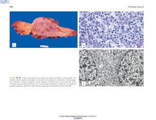 496 Patología especial
FIGURA 15-34. a) Pieza quirúrgica de un tumor de células de Merkel; tumor grande, mal
limitado; blanco grisáceo, del glúteo. b) Detalle microscópico de merkeloma; células peque-
ñas, uniformes, escaso citoplasma, núcleo redondo, cromatina fina sin nucleolo (HE x210).
c) Detalle de una célula de Merkel con el microscopio electrónico; exhibe en el citoplasma
gránulos pequeños uniformes electrodensos (gránulos neuroendocrinos) (ME 86,000).
(c)
(b)
(a)
© 2007 Editorial Médica Panamericana, S.A de C.V.
Cisfarm
 