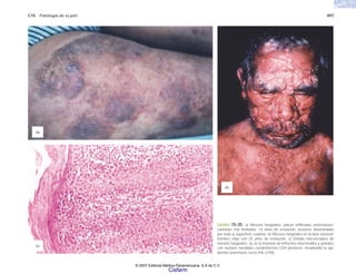 C15 Patología de la piel 497
(a)
(c)
(b)
FIGURA 15-35. a) Micosis fungoides; placas infiltradas eritematoes-
camosas mal limitadas; 14 años de evolución; lesiones diseminadas
por toda la superficie cutánea. b) Micosis fungoides en la fase tumoral;
hombre viejo con 25 años de evolución. c) Detalle microscópico de
micosis fungoides; se ve la invasión de linfocitos intermedios y grandes
con núcleos hendidos cerebriformes CD4 positivos, invadiendo la epi-
dermis (exocitosis seca) (HE x150).
© 2007 Editorial Médica Panamericana, S.A de C.V.
Cisfarm
 